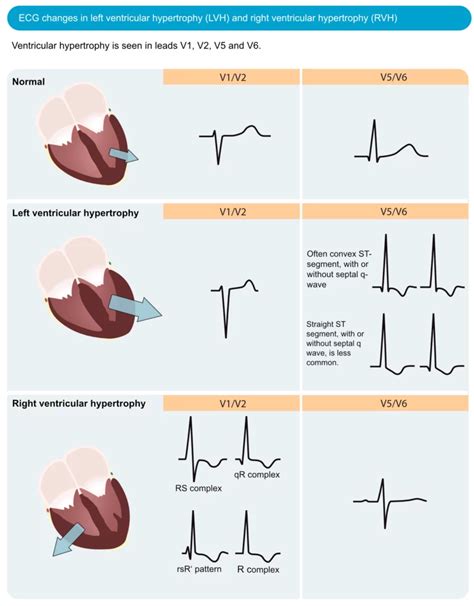 left ventricular hypertrophy by voltage